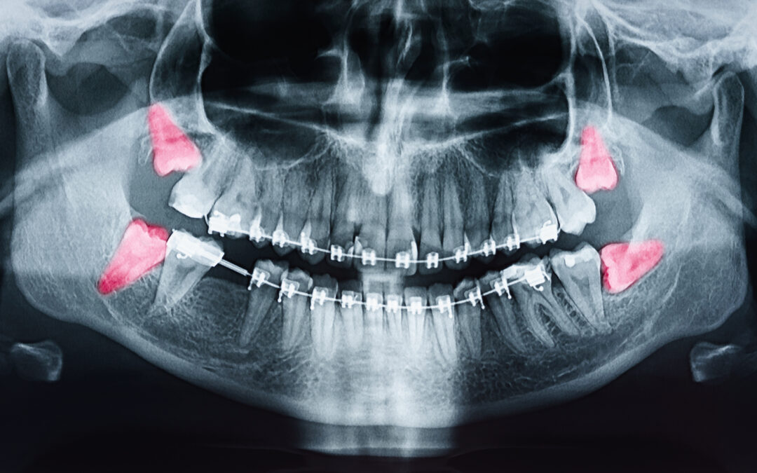 xray showing wisdom teeth