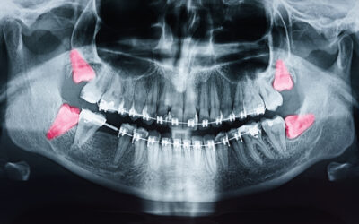 What to Expect When Getting Your Wisdom Teeth Removed